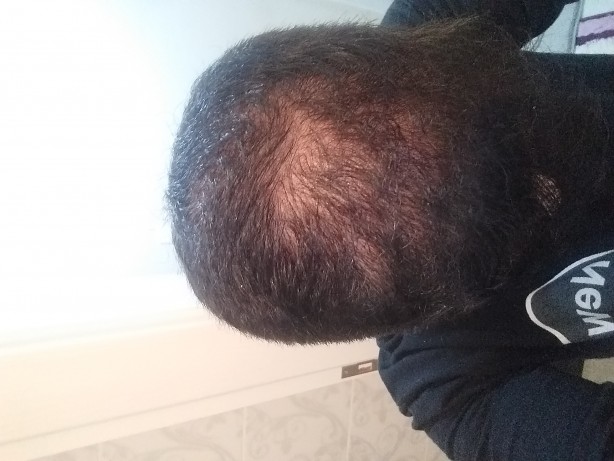 Foto - Saç dökülmesini azaltan 4 muhteşem yöntem