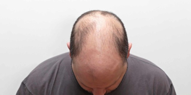 Foto - Saç dökülmesini azaltan 4 muhteşem yöntem