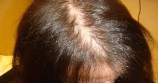 Foto - Saç dökülmesini durduran etkili tarçın maskesi tarifi: Kalıcı saç dökülmesinin nedenleri! Kel kalabilirsiniz