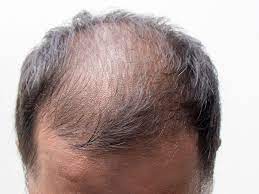 Foto - Saç dökülmesini durduran etkili tarçın maskesi tarifi: Kalıcı saç dökülmesinin nedenleri! Kel kalabilirsiniz