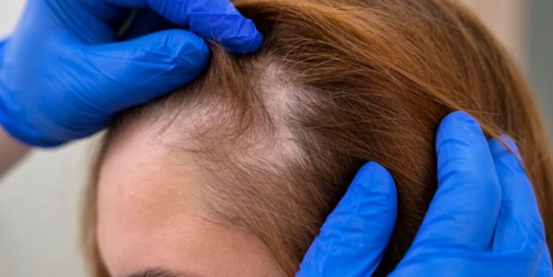 Foto - Saç dökülmesini engelleyen besinler