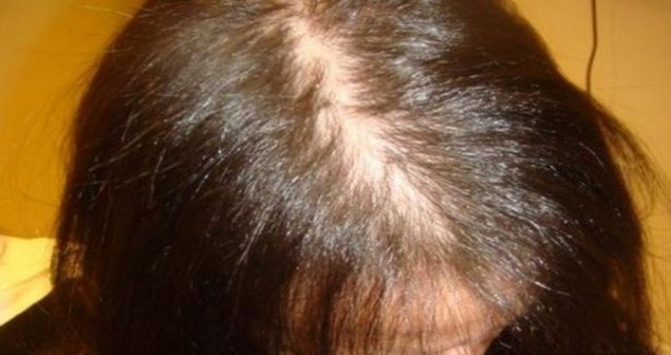 Foto - Saç dökülmesini engelleyen besinler