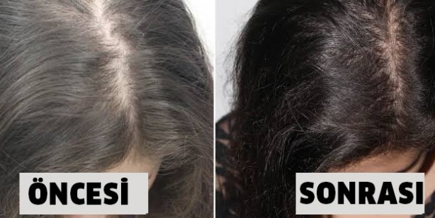 Saç dökülmesini hayatınızdan komple çıkaran bu tarifi mutlaka denemelisiniz, kıl fışkırıyor! Saçınız sağlıklı olsun!