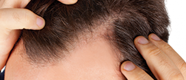 Foto - Saç dökülmesini önlemek istiyorsanız...