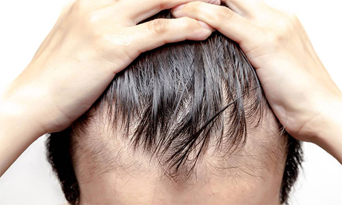 Foto - Saç dökülmesini önleyen 4 yöntem