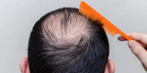 Saç dökülmesini önleyen 6 yiyecek