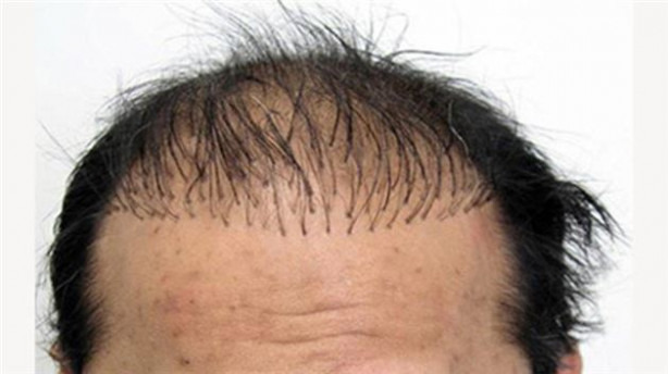 Foto - Saç ekimi tarihe karışıyor!