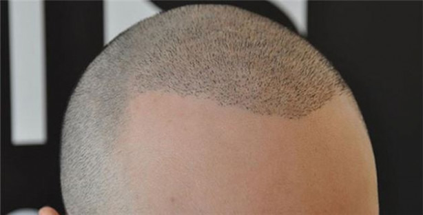 Saç ekimi tarihe karışıyor!