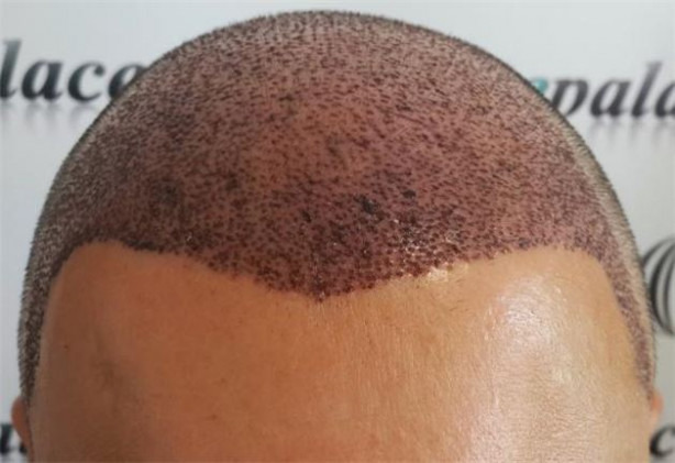 Foto - Saç ekimi tarihe karışıyor!