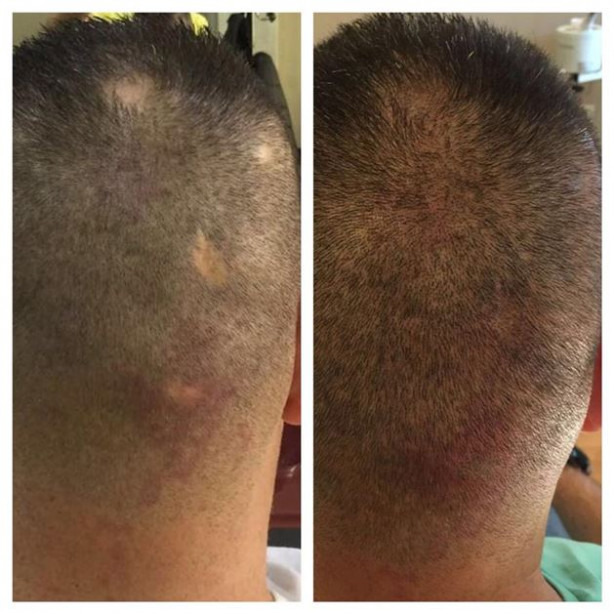 Foto - Saç ekimi tarihe karışıyor!