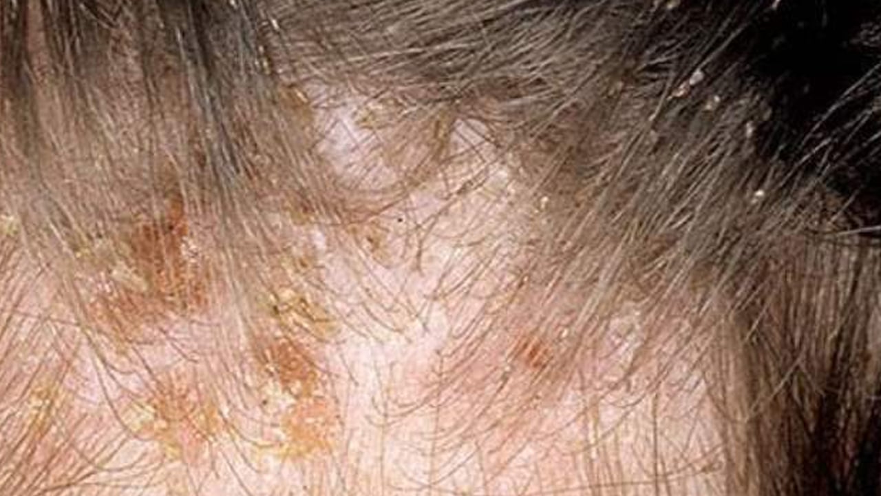 Saç yıkamak kepek oluşumuna davetiye çıkarıyor: Saç sağlığına ve saça riskleri nelerdir? Gizli tehlike ortaya çıktı