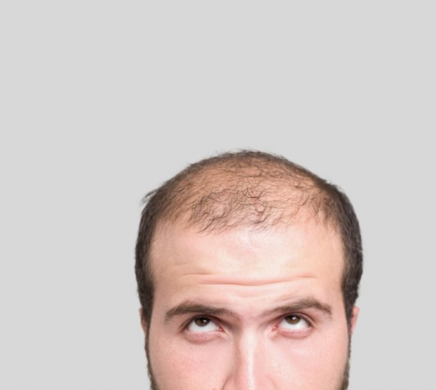 Saçı dökülenler dikkat! Durduruyor... Artık bu besinleri severek yiyeceksiniz