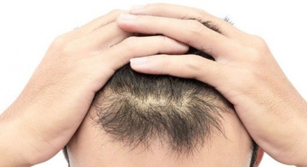 Foto - Saçı dökülenler dikkat! Durduruyor... Artık bu besinleri severek yiyeceksiniz