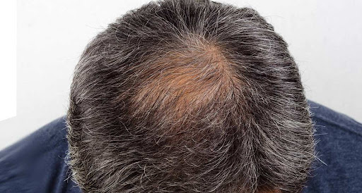 Foto - Saçı dökülenler dikkat! Sizde bu hastalıklar olabilir