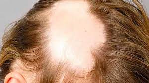 Foto - Saçkırana ne iyi gelir? Hemen nasıl geçer? Dikkat: saçınıza sürerken savunma yapan, savaş açan saç tarifi verdik!