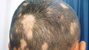 Foto - Saçkırana ne iyi gelir? Hemen nasıl geçer? Dikkat: saçınıza sürerken savunma yapan, savaş açan saç tarifi verdik!