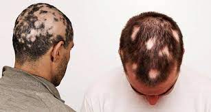 Foto - Saçkırana ne iyi gelir? Hemen nasıl geçer? Dikkat: saçınıza sürerken savunma yapan, savaş açan saç tarifi verdik!