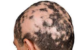 Foto - Saçkırana ne iyi gelir? Hemen nasıl geçer? Dikkat: saçınıza sürerken savunma yapan, savaş açan saç tarifi verdik!