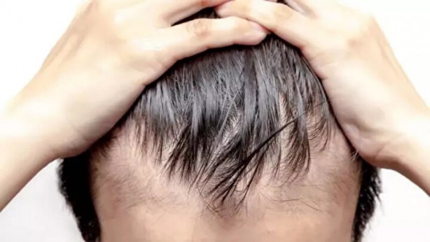 Foto - Saçları dökülenler bu habere dikkat: Bir avuç tüketmek bile etki ediyor