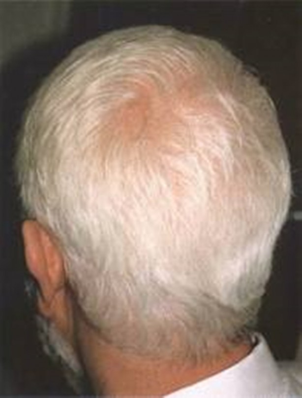 Foto - Saçların beyazlamasını önlemek için ipuçları