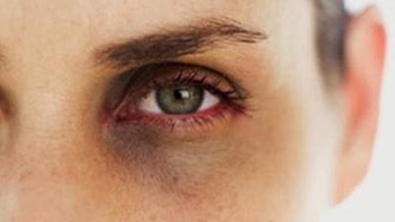 Foto - Sadece 15 dakikada sürecek! İşte göz altı morluklarından kurtulmanın yolu