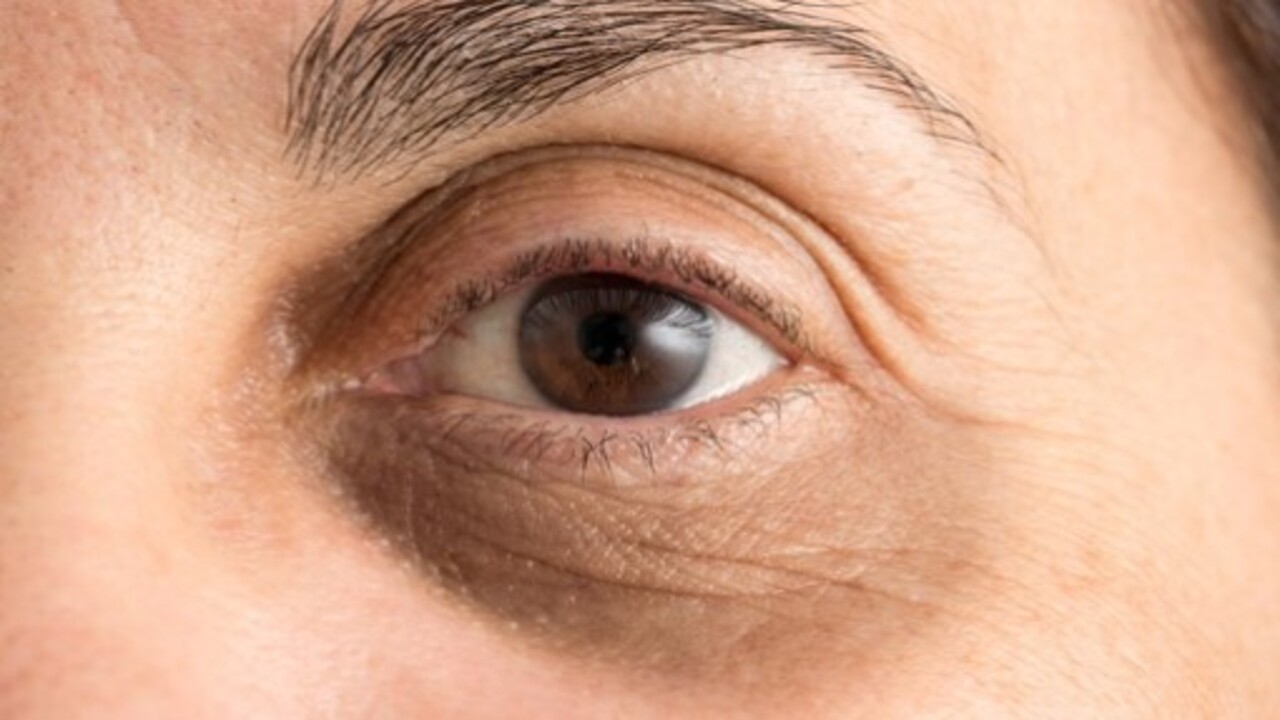 Sadece 15 dakikada sürecek! İşte göz altı morluklarından kurtulmanın yolu