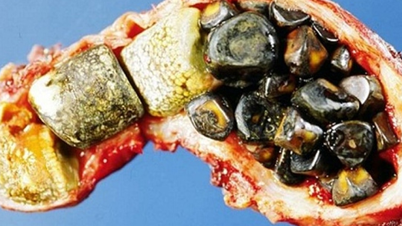 Foto - Safra kesesi taşlarında kritik uyarı: Küçük taşları olanlar daha büyük risk taşıyor 