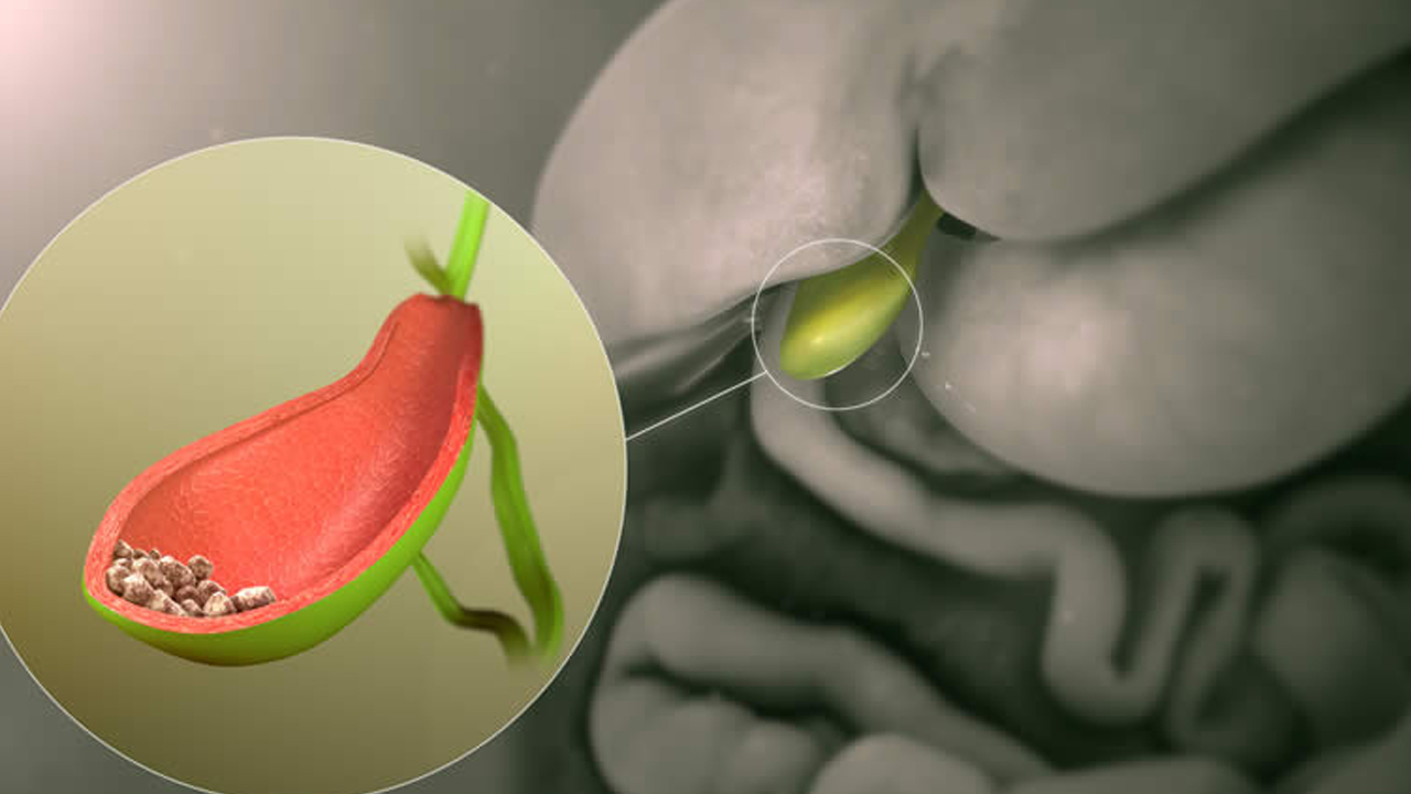 Safra kesesi taşlarında kritik uyarı: Küçük taşları olanlar daha büyük risk taşıyor 