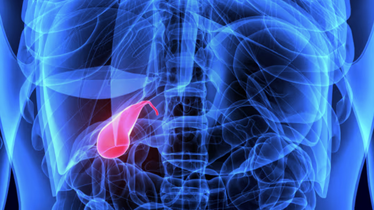 Foto - Safra kesesi taşlarında kritik uyarı: Küçük taşları olanlar daha büyük risk taşıyor 