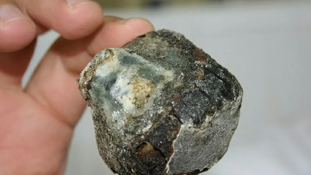 Foto - Safra kesesi taşlarında kritik uyarı: Küçük taşları olanlar daha büyük risk taşıyor 