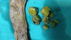 Foto - Safra kesesi taşlarını 7 günde düşüren doğal yöntem efsane: Pek bilinmeyen uygulama! Adeta savaş açıyor