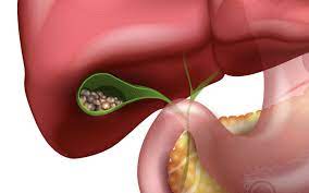 Safra kesesi taşlarını 7 günde düşüren doğal yöntem efsane: Pek bilinmeyen uygulama! Adeta savaş açıyor