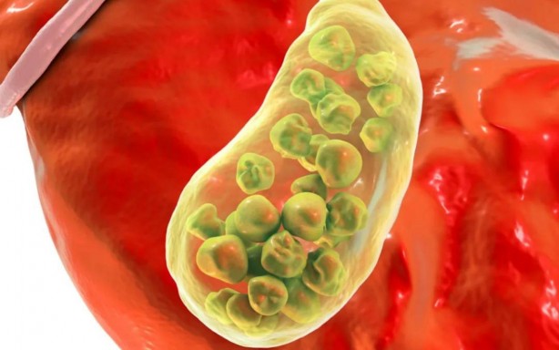 Foto - Safra kesesinden çıkan taş büyüklüğü şoke etti!