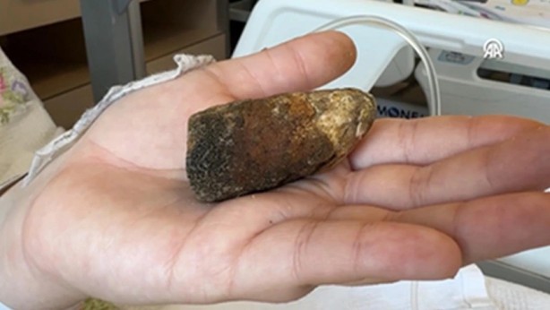 Safra kesesinden çıkan taş büyüklüğü şoke etti!