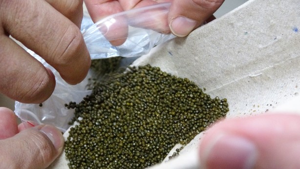 Foto - Safra kesesinden çıkanlar doktorları bile şoke etti! Guinness'e başvuru yapacaklar