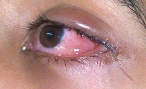 Foto - Sağlık Bakanlığından kritik uyarı: "Bu belirtileri yaşıyanlar mutlaka hekime başvursun"