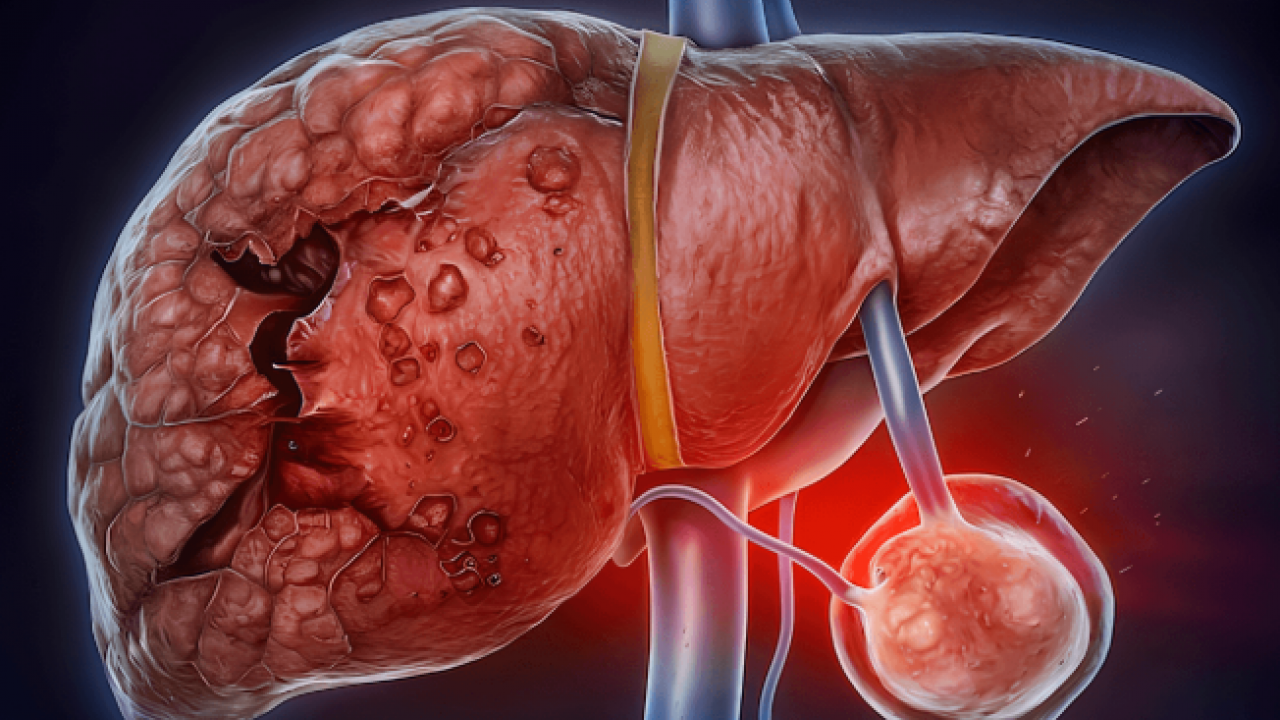 Sağlıklı besin diye anlatılıyor: İşte karaciğeri en çok yoran 3 yiyecek!