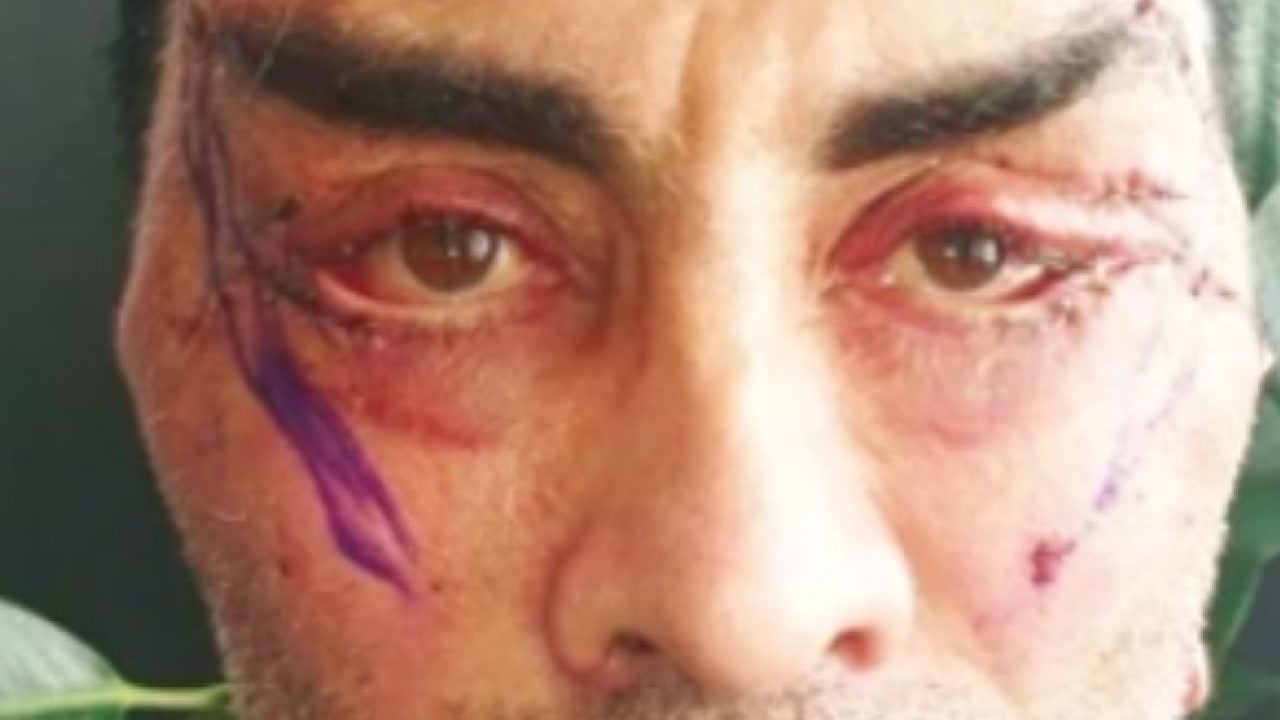 Foto - Şakak, boyun, yüz germe derken: Gençleşmek isterken hayatı kabusa döndü! Gözlerini kapatamıyor