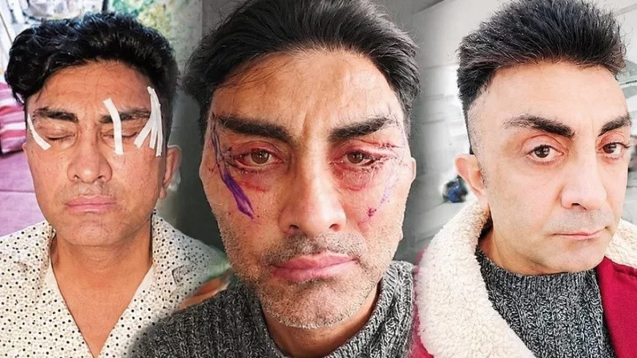 Foto - Şakak, boyun, yüz germe derken: Gençleşmek isterken hayatı kabusa döndü! Gözlerini kapatamıyor