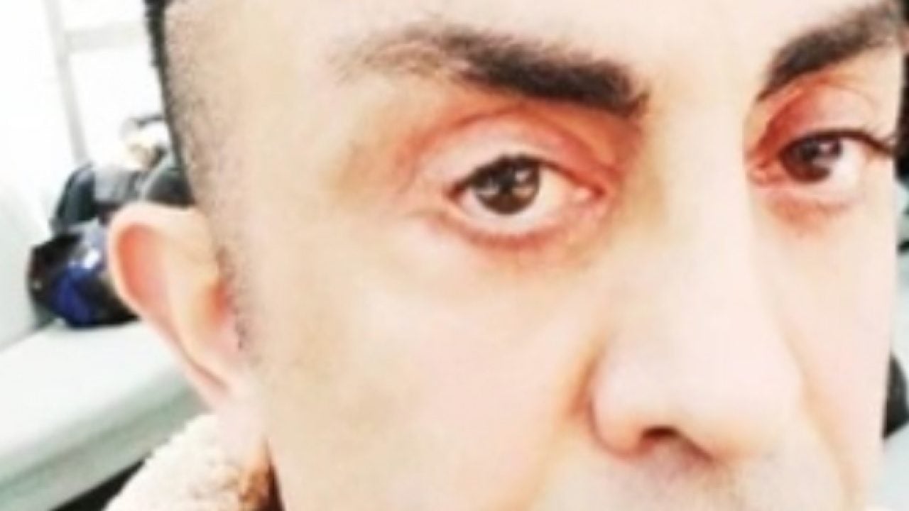 Şakak, boyun, yüz germe derken: Gençleşmek isterken hayatı kabusa döndü! Gözlerini kapatamıyor