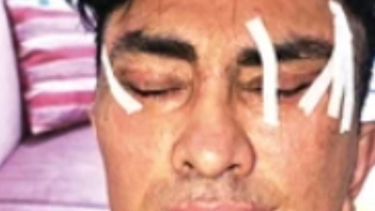 Foto - Şakak, boyun, yüz germe derken: Gençleşmek isterken hayatı kabusa döndü! Gözlerini kapatamıyor