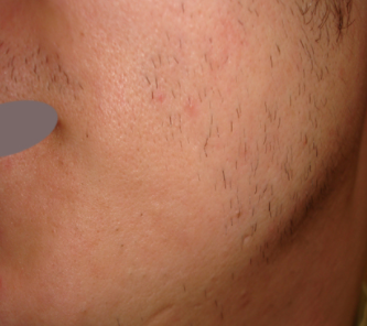 Foto - Sakalını koparanlar dikkat! Nasıl olur? İşte en kolay yöntemler…