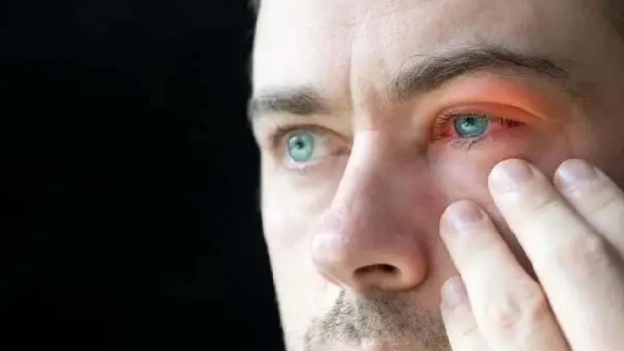 Foto - Sakın ihmal etmeyin: Göz kızarıklığı o hastalığın habercisi!