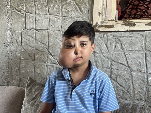 Foto - Sanki iki farklı yüzü var...! Hastalığı için yardım bekliyor