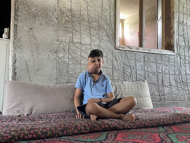 Foto - Sanki iki farklı yüzü var...! Hastalığı için yardım bekliyor