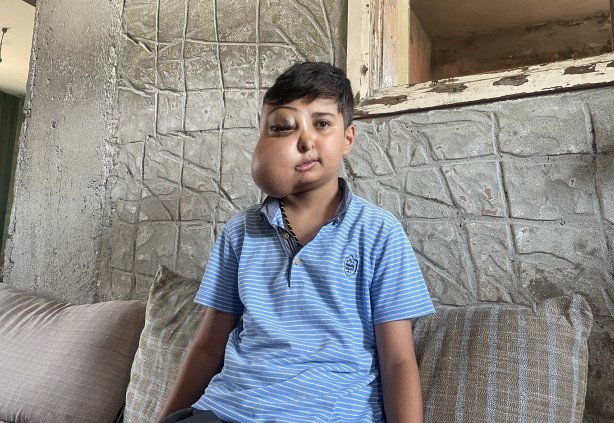 Sanki iki farklı yüzü var...! Hastalığı için yardım bekliyor