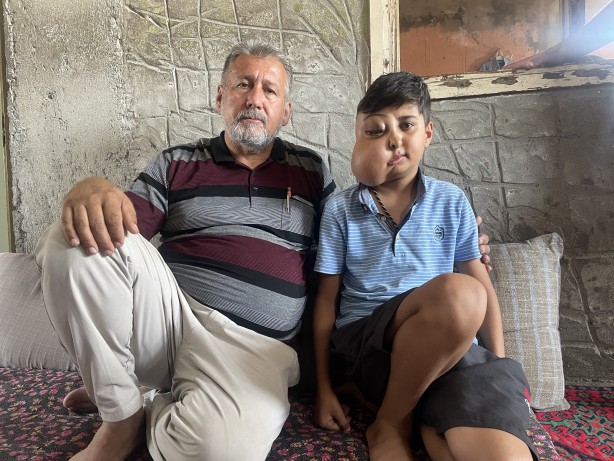 Foto - Sanki iki farklı yüzü var...! Hastalığı için yardım bekliyor