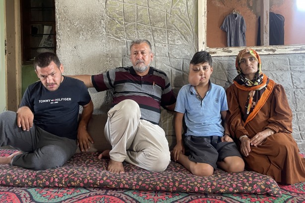 Foto - Sanki iki farklı yüzü var...! Hastalığı için yardım bekliyor