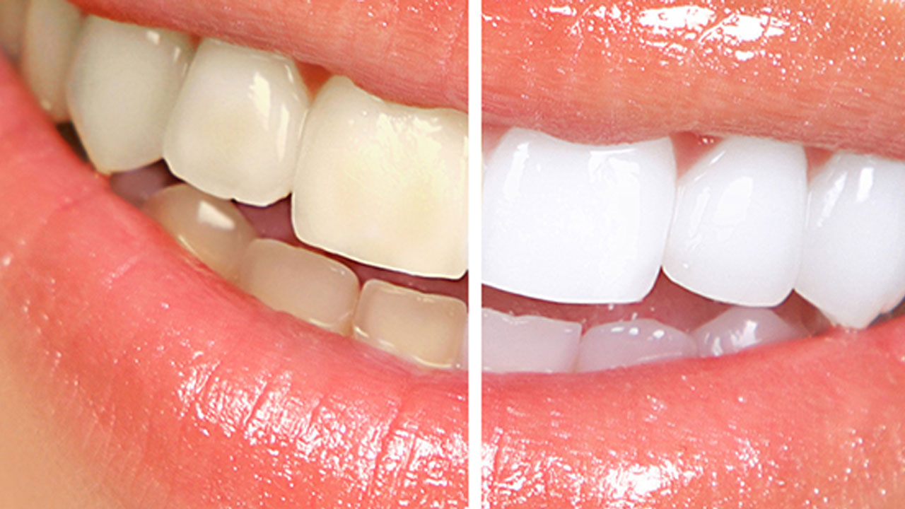 Sararan dişlerin kolay çözümü! Dişleri bembeyaz yapan doğal yöntem açıklandı