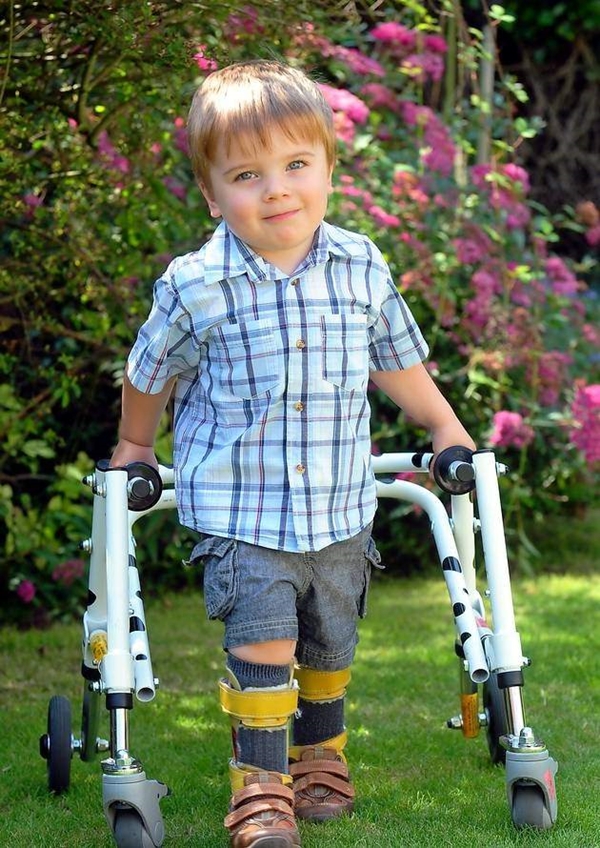 Foto - Serebral Palsi hastalığının belirtileri 